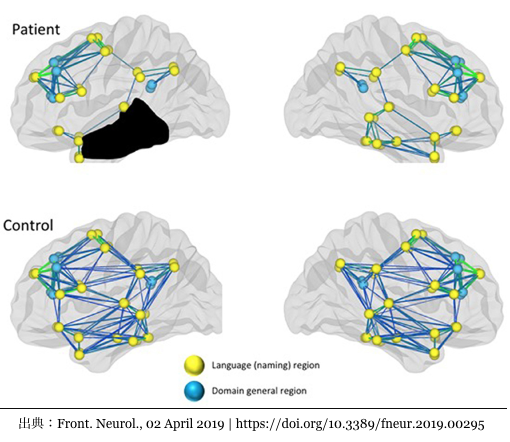 Figure 2. Reduced connectivity in both language and domain-general networks in a patient with aphasia compared to healthy controls.：PT・OT・STニュース.blog リハビリ1分間アップデート