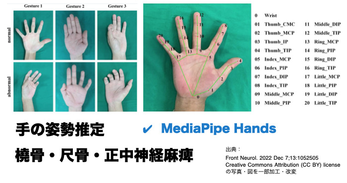 姿勢推定 MediaPipe Hands - 末梢神経麻痺の手の肢位を自動検出 出典：Front Neurol 2022 Dec 7；13：1052505 Creative Commons Attribution （CC BY）licenseの写真・図を一部改変