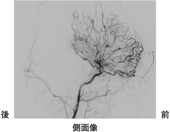 脳血管造影検査の側面像：PT60PM41