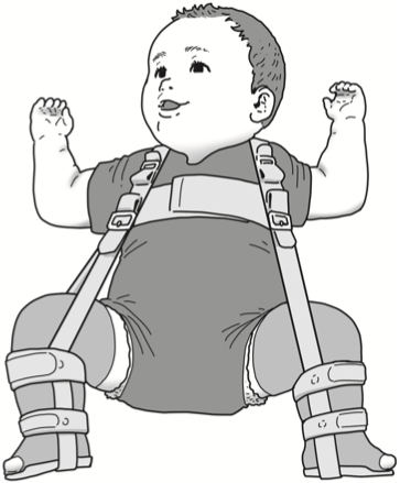 乳幼児の装具療法:PT61PM34
